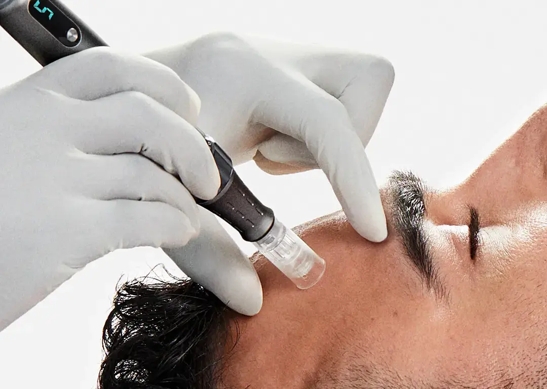 1x1-Microneedling-Model-10-1080 (1)